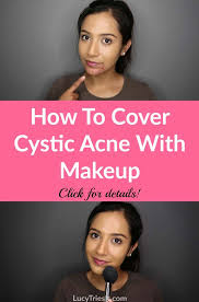how to cover cystic acne with makeup