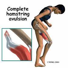 hamstring injuries of the knee sports