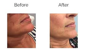 cosmetic spider vein treatment