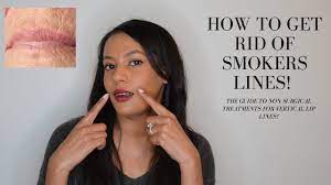 how to get rid of lip lines best