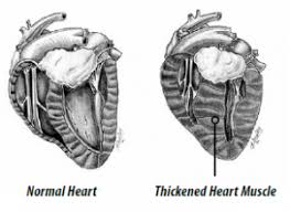Congestive heart failure is a progressive disease whose outlook is often poor, but certain factors can improve life expectancy, prognosis, and survival rates. Feline Hypertrophic Cardiomyopathy Hcm Medvet