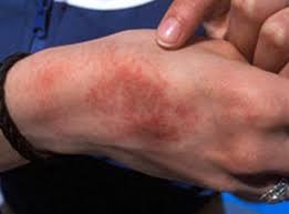 heat rash pictures symptoms causes