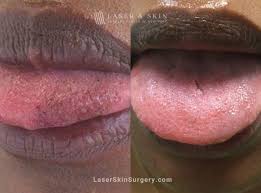 dark spots on tongue laser ny