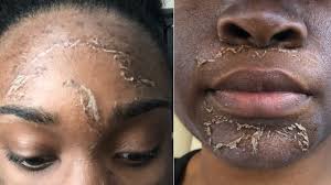 Typically, acne hyperpigmentation affects both men and women of all skin types, particularly chemical peels are exfoliating treatments that help eliminate dead and darkened skin cells from the. I Got A Chemical Peel For Hyperpigmentation Before After Results Youtube