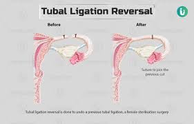tubal ligation reversal procedure