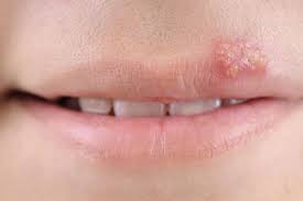 cold sores signs and treatments