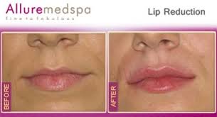 lip reduction surgery allure med spa