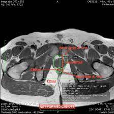 axial mri merements taken at level