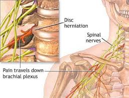 treatment of pinched nerve in the neck