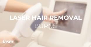 laser hair removal burn everything you