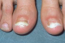 7 effective toenail fungus treatments
