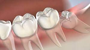 We have everything you are looking for! Post Operative Instructions Following Wisdom Tooth Extractions At Oral Surgery Specialists Of Oklahoma