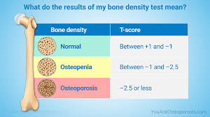 screening and diagnosing bone health