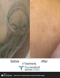 picosure laser tattoo removal before