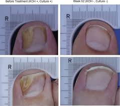 toenail onychomycosis ilrative