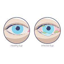 midtown optometry 3 types of pink eye