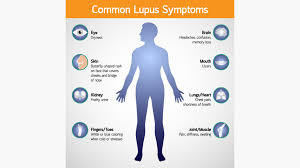 lupus arthritis treatment center