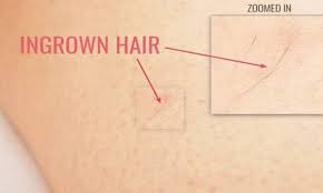 Commonly called razor bumps, ingrown hairs look like a little pimple, a red bump which is raised on the skin. How To Get Rid Of Ingrown Hairs On Legs Fast 10 Best Ways