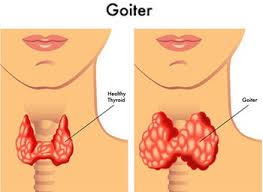 home remes for goiter natural treatment