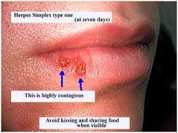 herpes cold sores sun and fever blisters