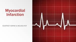 Myocardial infarction mi is defined as a diseased condition which is caused by reduced mi or heart attack is the irreversible damage of myocardial tissue caused by prolonged ischaemia 9. Ppt Myocardial Infarction Powerpoint Presentation Free Download Id 4269683