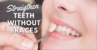 how to straighten teeth without braces
