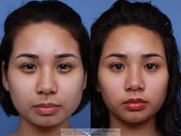 Maybe you would like to learn more about one of these? Botox Dysport In Boston Hingham Nantucket Ma Coastal Plastic Surgery