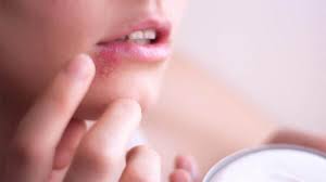 what causes cold sores and the most