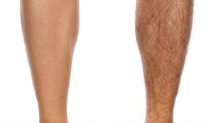 remove unwanted hair on legs