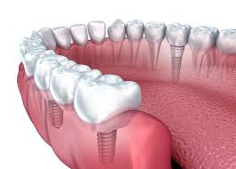 guide to dental implants a por