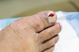a podiatrist for an ingrown toenail