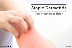 atopic dermais tips advice from