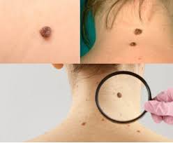 mole removal surgery singapore