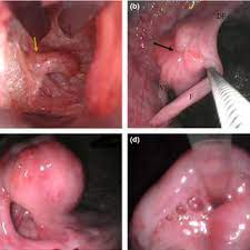 oscopic examination of the cervix