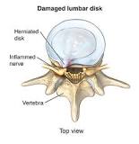 Image result for icd 10 code for lumbar hnp with radiculopathy