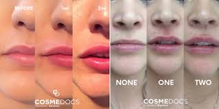 lip fillers before and after photos at