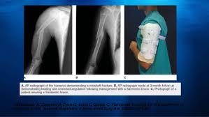 Little evidence regarding the extent of recovery of radial nerve lesions with associated humerus trauma exists. Fracture Humerus Shaft In Adults