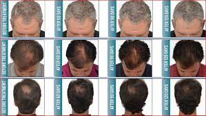 Progressive/active hair loss/thinning within the last 12 months. Lllt Low Level 650nm 670nm Diode Laser Therapy Hair Regrowth System Bs Ll7h Lumsail Medical Aesthetics Industrial Inc