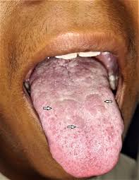 Syphilis is a sexually transmitted infection caused by the bacterium treponema pallidum. Secondary Syphilis Presenting As Oral Ulcers Archives Of Disease In Childhood