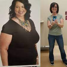 gastric sleeve before and after photos