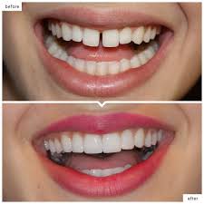 While braces are typically considered the best way to straighten teeth, not everyone likes the metallic look of traditional braces. How To Straighten Teeth Without Braces Teethwalls