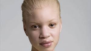 albino black person kenosha robinson