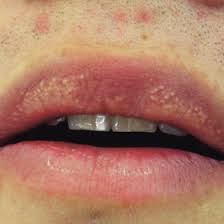 upper lip with fordyce granules