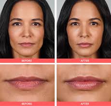 juvederm ultra xc for lips in