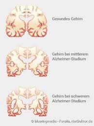 Alzheimer's disease is the most common type of dementia. Alzheimer Symptome Ursachen Verlauf Vorbeugung Netdoktor