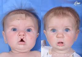 cleft lip repair before after photos