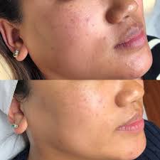 skin needling thi aim obsessed with