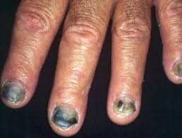 nail fungus infections hoogstra