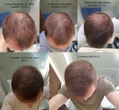 acell prp hair regrowth therapy