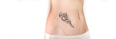 can tattoos cover stretch marks